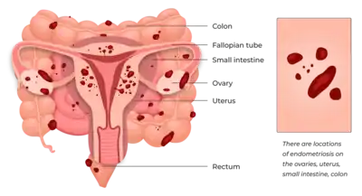 endometriosis and infertility pregnancy illustration