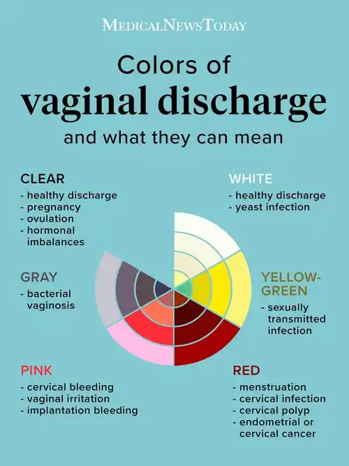 Dr Mamta Agrawal Best Gynaecologist “Colors of vaginal discharge chart showing clear, white, yellow-green, gray, pink, and red discharge with their possible health meanings”