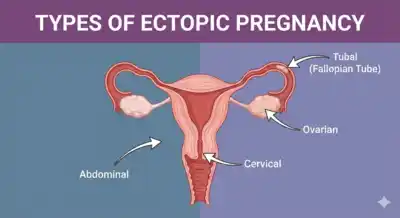 Diagram showing types of ectopic pregnancy including tubal, ovarian, cervical, and abdominal implantation

