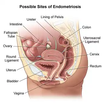 Dr Mamta Agrawal Best Gynaecologist Diagram showing possible sites of endometriosis in the female reproductive system