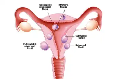 Diagram showing different types of uterine fibroids and their locations in the uterus