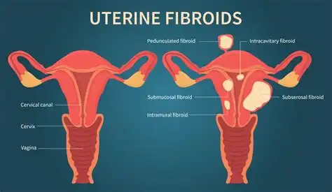 Illustration showing different types of uterine fibroids, including submucosal, intramural, and subserosal fibroids in the uterus
